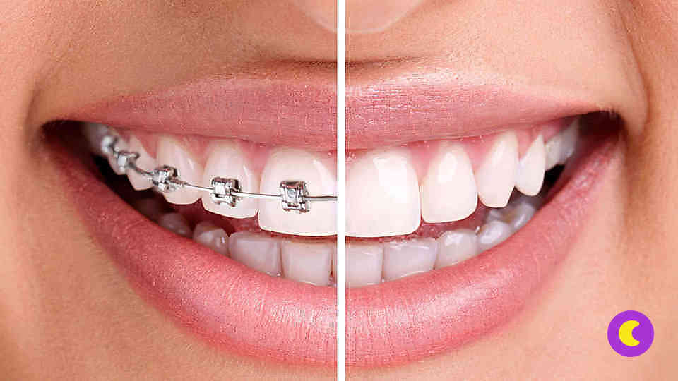 Элайнеры для выравнивания зубов: что лучше - каппы-элайнеры или брекеты?