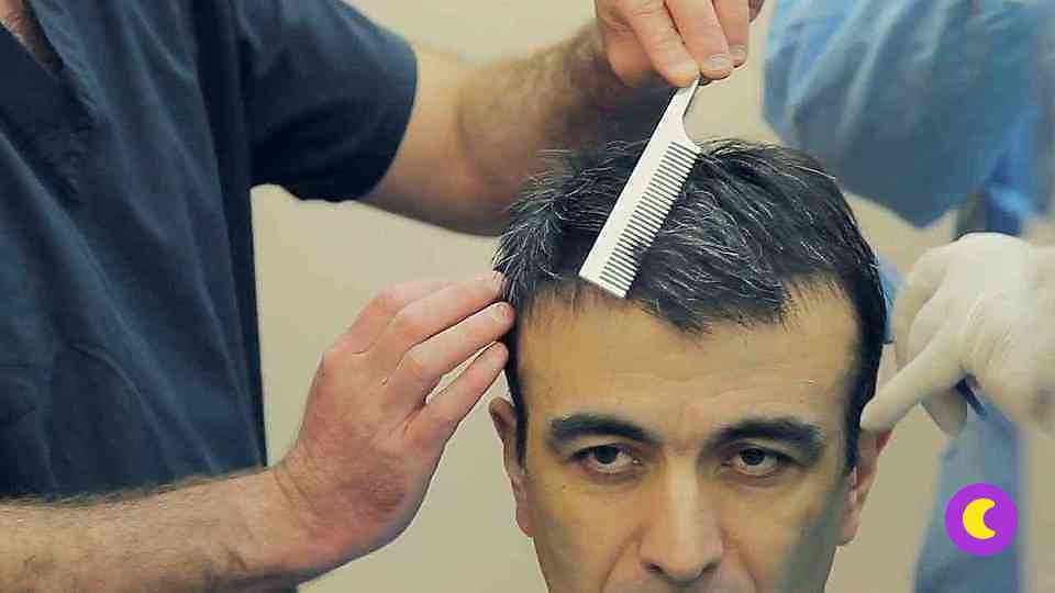 Алопеция (облысение): лоскутный метод пересадки волос